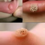 Estos son los primeros signos de un enf: El Arte de Eliminar Verrugas con Remedios Caseros Efectivos