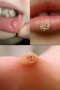 Estos son los primeros signos de un enf: El Arte de Eliminar Verrugas con Remedios Caseros Efectivos