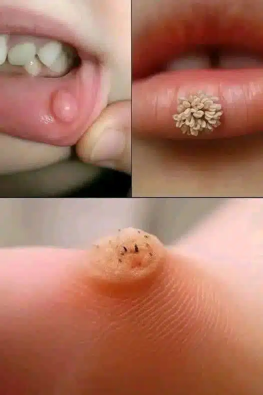 Estos son los primeros signos de un enf: El Arte de Eliminar Verrugas con Remedios Caseros Efectivos